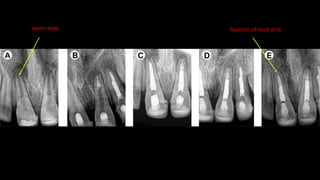 Apexification and Apexogenesis | PPTX