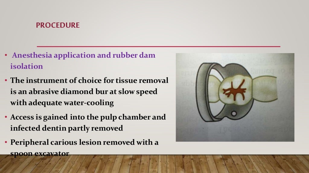 Apexification and Apexogenesis
