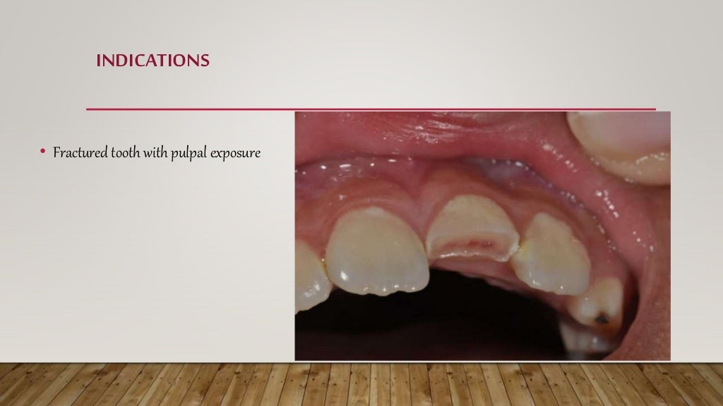 Apexification and Apexogenesis