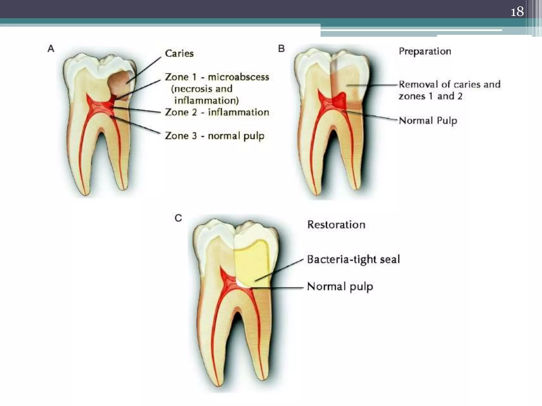 Apexification & apexogenesis | PPTX
