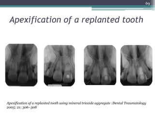 Apexification & apexogenesis | PPTX