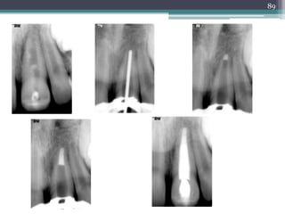 Apexification & apexogenesis | PPTX