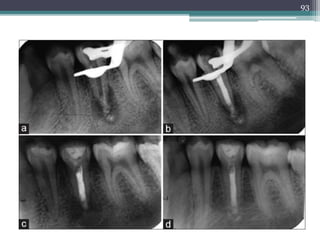 Apexification & apexogenesis | PPTX