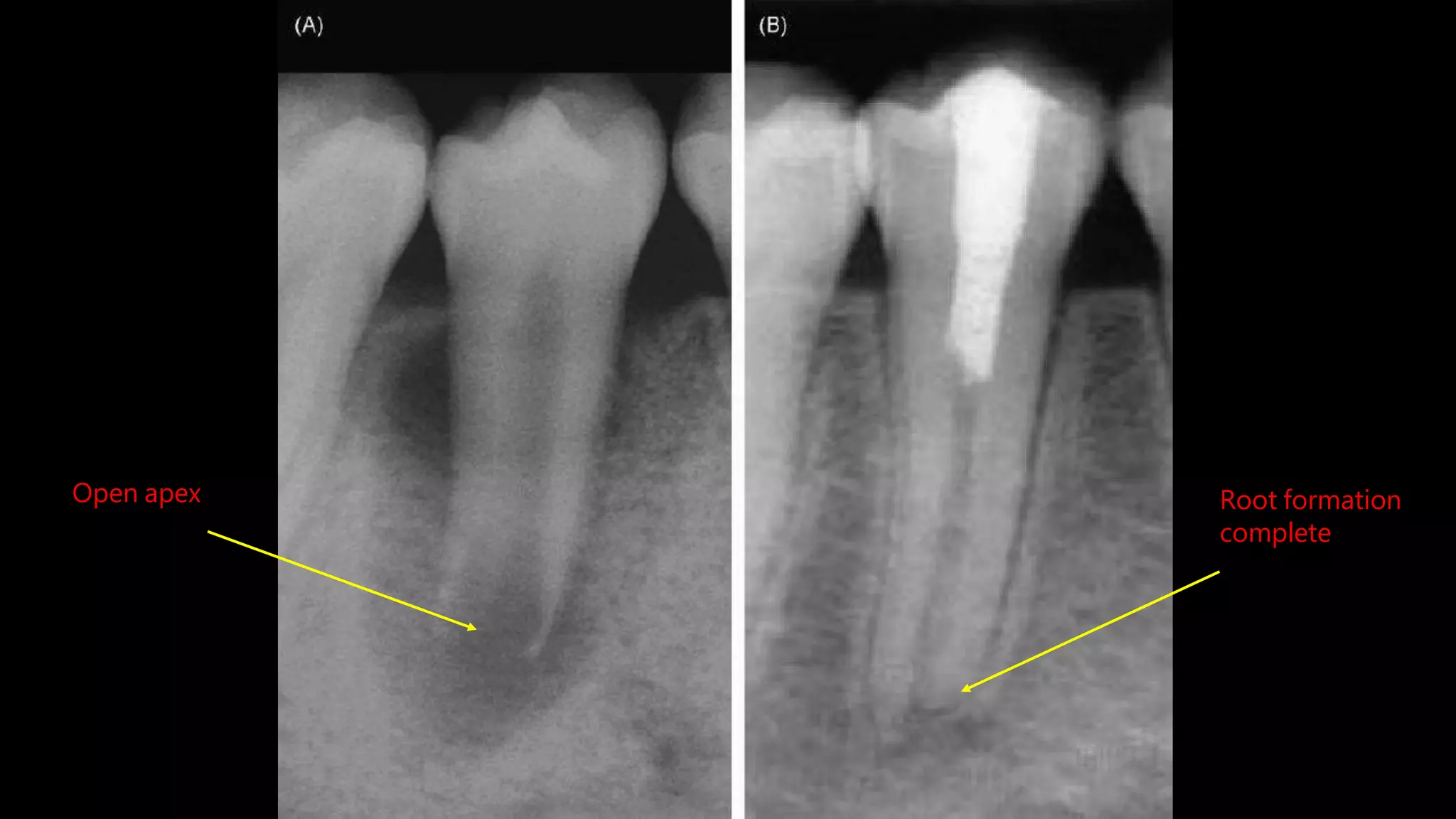 Open apex Root formation
complete
 
