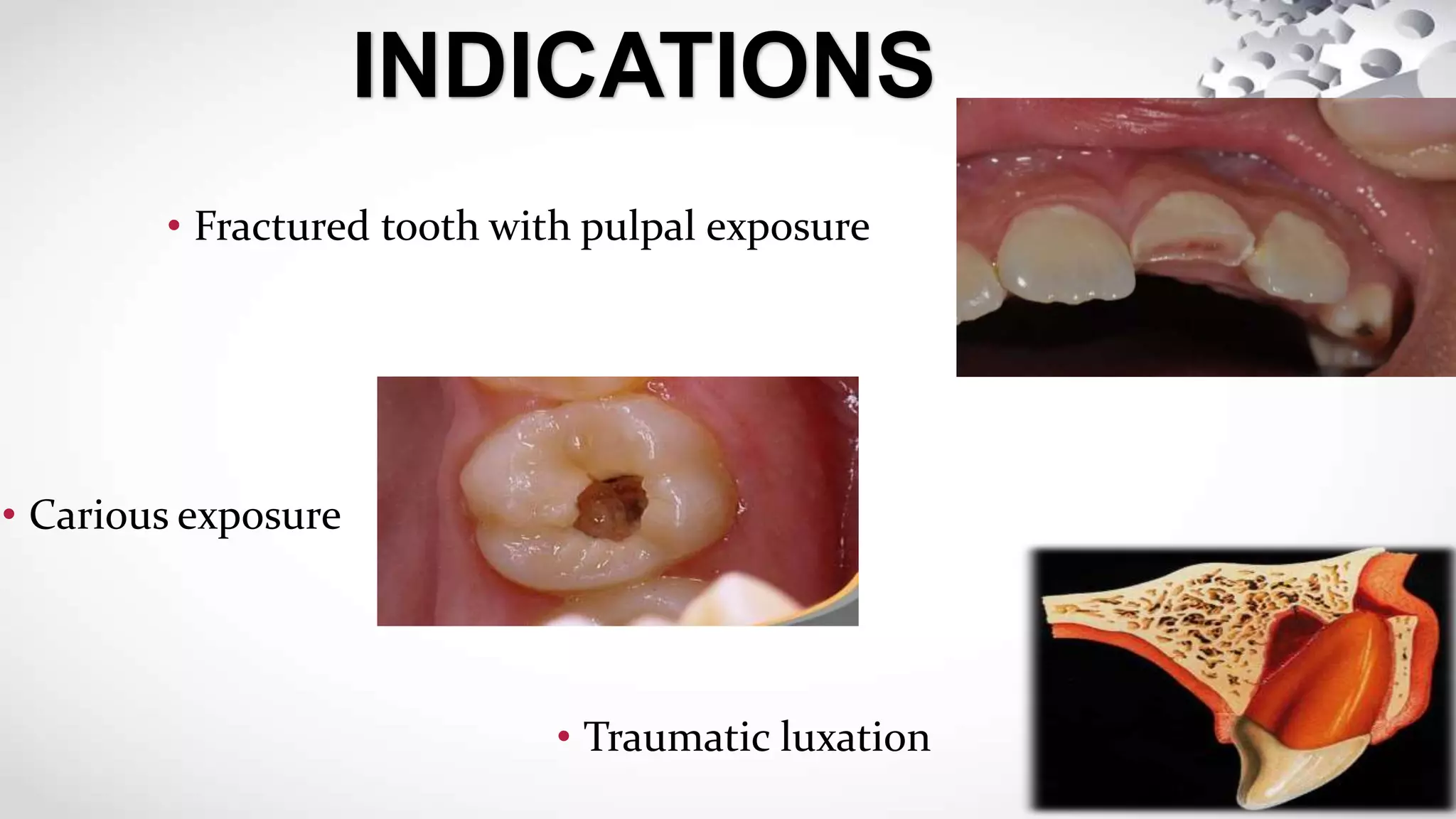 • Fractured tooth with pulpal exposure
INDICATIONS
• Carious exposure
• Traumatic luxation
 