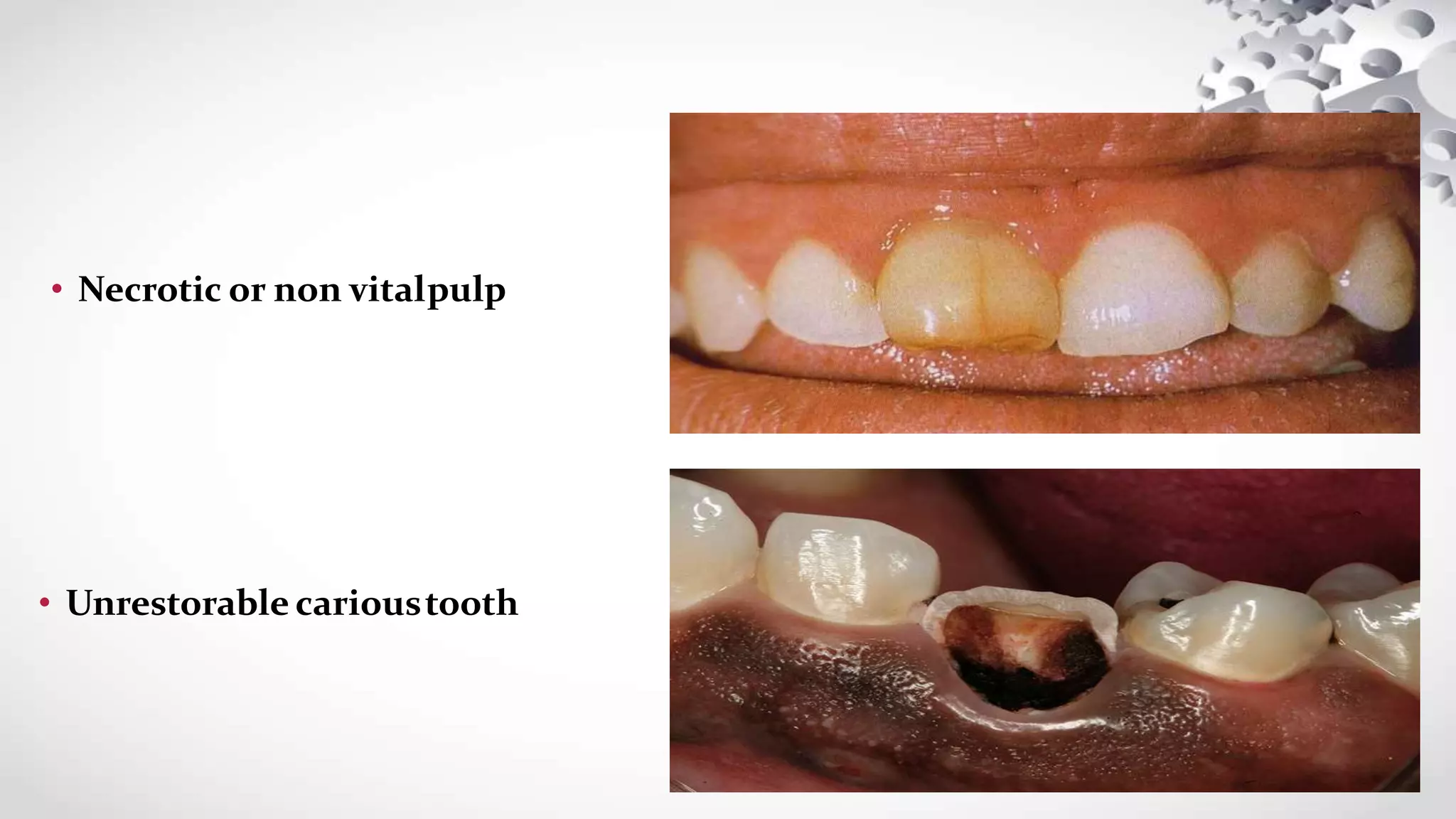 • Necrotic or non vitalpulp
• Unrestorable carioustooth
 
