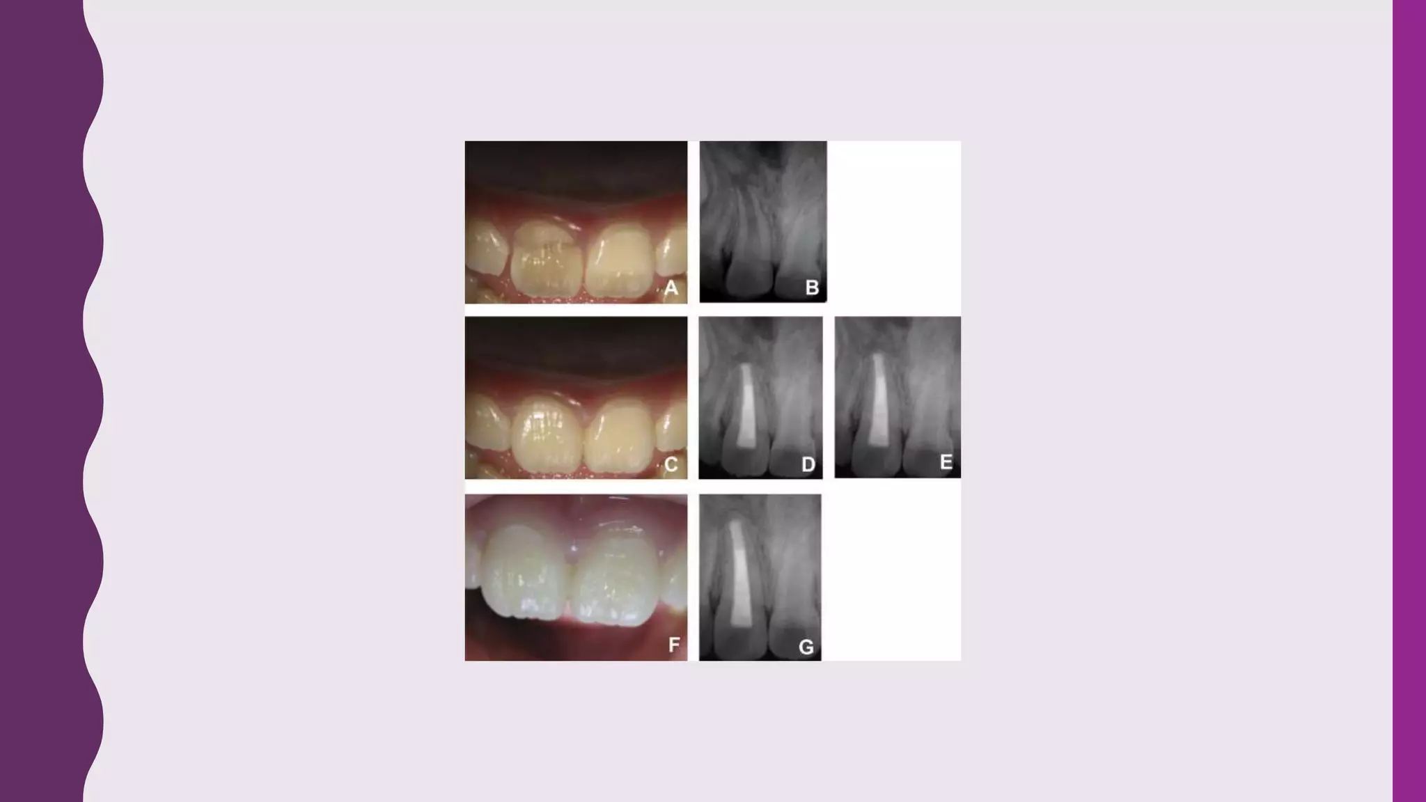 Apexogenesis and apexification | PPTX