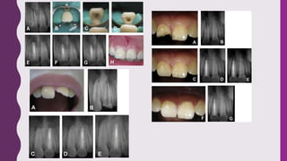 Apexogenesis and apexification | PPTX