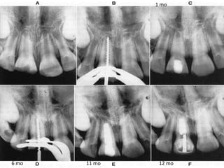 Apexogenesis & apexification | PPTX