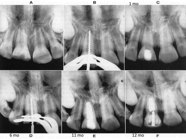 Apexogenesis & apexification | PPTX | Dental Health | Diseases and ...