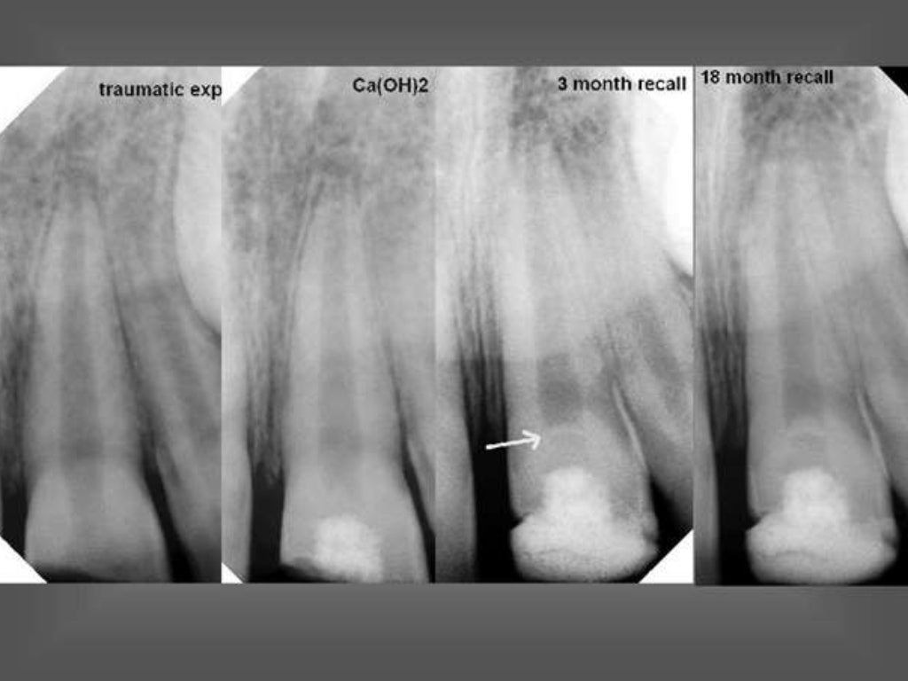 Apexogenesis & apexification