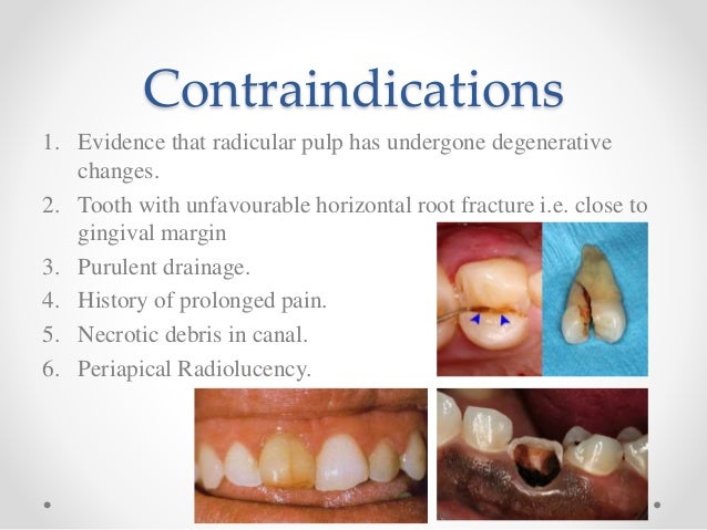 apexification