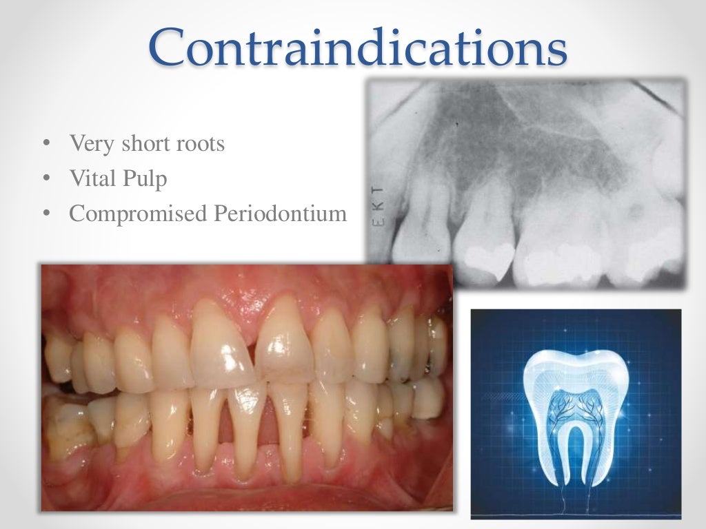 Apexogenesis & apexification in pediatric dentistry