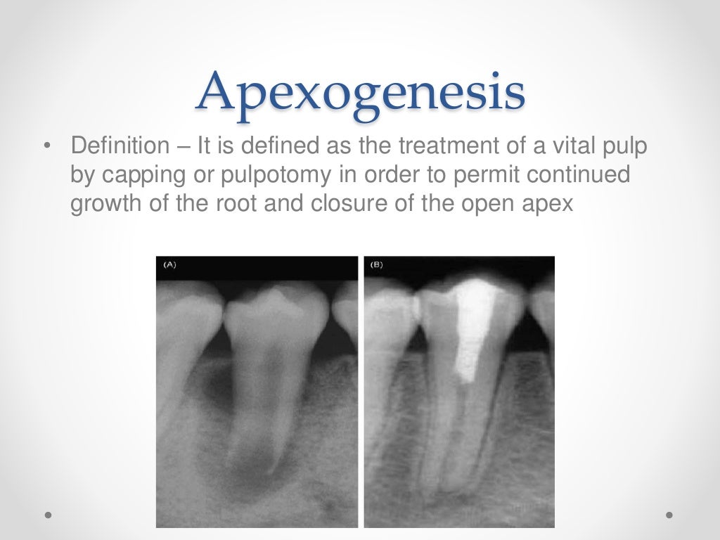 Apexogenesis & apexification in pediatric dentistry