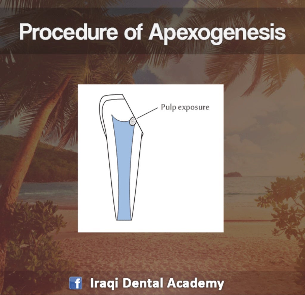 Apexogenesis Procedure A Pediatric Lecture