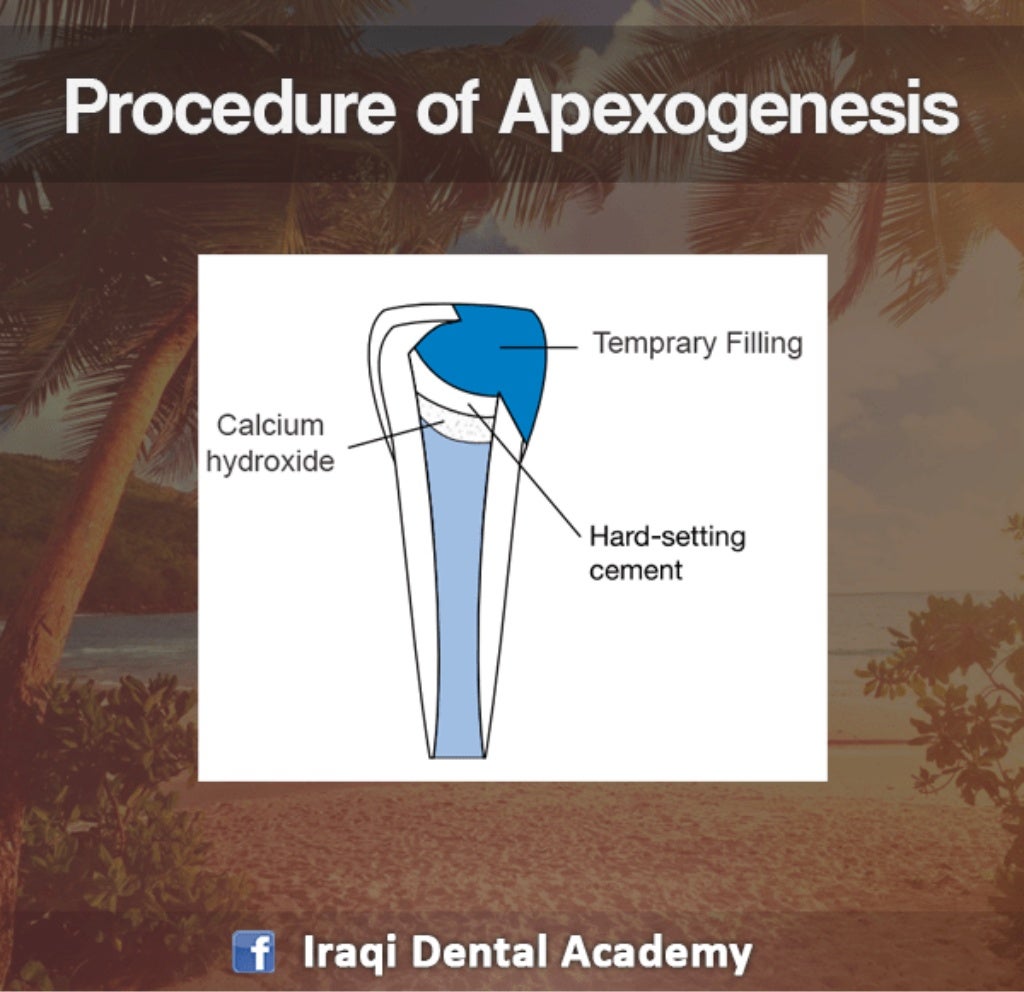 Apexogenesis Procedure A Pediatric Lecture