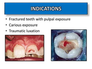 INDICATIONS
• Fractured teeth with pulpal exposure
• Carious exposure
• Traumatic luxation
 