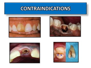 CONTRAINDICATIONS
 