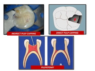 INDIRECT PULP CAPPING DIRECT PULP CAPPING
PULPOTOMY
 