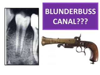BLUNDERBUSS
CANAL???
 