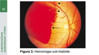101
SUBARACNÓIDEA
HEMORRAGIA
VÍTREA
 