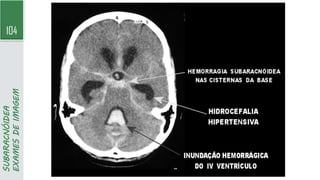 104
SUBARACNÓIDEA
EXAMES
DE
IMAGEM
 