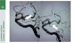 105
SUBARACNÓIDEA
EXAMES
DE
IMAGEM
 