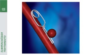 108
SUBARACNÓIDEA
TRATAMENTO
 