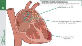 51
ETIOLOGIA
CARDIOEMBÓLICO
► Cardioembolia: embolização de coágulos gerados no coração
- IAM com áreas de acinesia, FOP, miocardiopatias e valvopatias
- recanalização: possibilidade tardia, gerando circulação por tecido necrótico com possível
extravasamento sanguíneo intraparenquimatoso (tranformação hemorrágica)
 