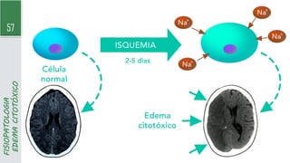 57
FISIOPATOLOGIA
EDEMA
CITOTÓXICO
 