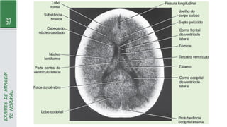 67
EXAMES
DE
IMAGEM
TC
NORMAL
 