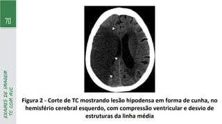 70
EXAMES
DE
IMAGEM
TC
COM
AVC
 