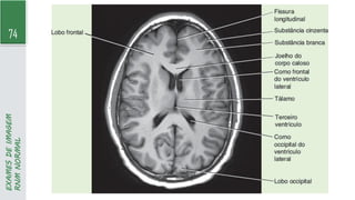 74
EXAMES
DE
IMAGEM
RNM
NORMAL
 