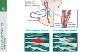 86
USG
COM
DOPPLER
DE
CARÓTIDAS
 