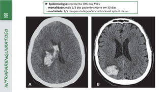 89
INTRAPARENQUIMATOSO
► Epidemiologia: representa 10% dos AVCs
- mortalidade: mais 1/3 dos pacientes morre em 30 dias
- morbidade: 1/5 recupera independência funcional após 6 meses
 
