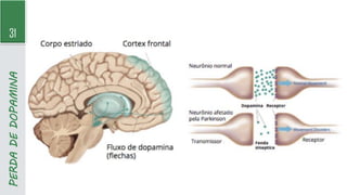 31
PERDA
DE
DOPAMINA
 