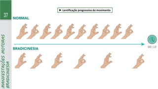 37
MANIFESTAÇÕES
MOTORAS
BRADICINESIA
► Lentificação progressiva do movimento
 