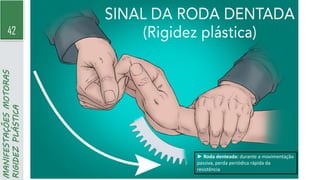 42
MANIFESTAÇÕES
MOTORAS
RIGIDEZ
PLÁSTICA
► Roda denteada: durante a movimentação
passiva, perda periódica rápida da
resistência
 