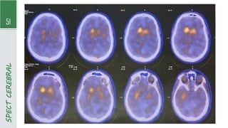 51
SPECT
CEREBRAL
 