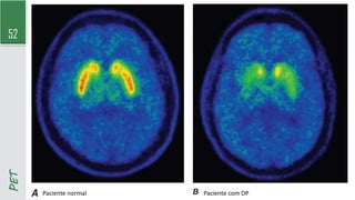 52
PET
Paciente normal Paciente com DP
 
