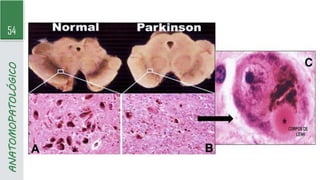 54
ANATOMOPATOLÓGICO
 
