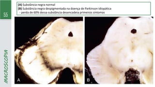 55
MACROSCOPIA (A) Substância negra normal
(B) Substância negra despigmentada na doença de Parkinson idiopática
- perda de 60% dessa substância desencadeia primeiros sintomas
 