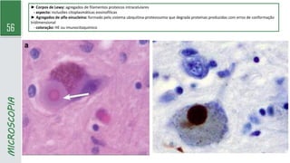 56
MICROSCOPIA
► Corpos de Lewy: agregados de filamentos proteicos intracelulares
- aspecto: inclusões citoplasmáticas eosinofílicas
► Agregados de alfa-sinucleína: formado pelo sistema ubiquitina-proteossoma que degrada proteínas produzidas com erros de conformação
tridimensional
- coloração: HE ou imunocitoquímico
 