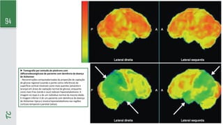 94
TC
► Tomografia por emissão de pósitrons com
18fluorodesoxiglicose de paciente com demência da doença
de Alzheimer
- Reconstruções computadorizadas da proporção de captação
de glicose regional (usando a ponte como referência) da
superfície cortical mostram cores mais quentes (amarelo e
laranja) em áreas de captação normal de glicose, enquanto
cores mais frias (verde e azul) indicam hipometabolismo. A
imagem no topo é a de um indivíduo normal da mesma idade.
A imagem inferior é de um paciente com demência da doença
de Alzheimer típica e mostra hipometabolismo nas regiões
corticais temporal e parietal (setas).
 