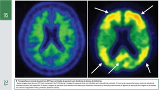 95
TC
► Tomografia por emissão de pósitrons (PET) para amiloides de paciente com demência da doença de Alzheimer.
- Nessa imagem axial de uma PET com composto B de 11Pittsburg, a imagem à esquerda é de um indivíduo sem retenção de amiloide. O sinal verde representa baixos níveis de adesão de
substância branca não específica. À direita, imagem de paciente com demência da doença de Alzheimer mostrando a retenção proeminente do agente de aquisição de imagem de amiloides
nos córtices cingulados frontal, parietal e posterior (setas).
 