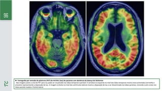 96
TC
► Tomografia por emissão de pósitrons (PET) de AV1451 (tau) de paciente com demência da doença de Alzheimer
- Nas imagens axiais o sinal de PET para tau pode ser visualizado nos lobos temporal e parietal. A varredura à esquerda no nível dos lobos temporais mostra sinal aumentado (vermelho e
amarelo) representando a deposição de tau. A imagem à direita no nível dos ventrículos laterais mostra a deposição de tau a ser disseminada nos lobos parietais, incluindo o pré-cúneo nos
lobos parietal medial e frontal lateral.
 