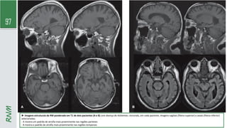97
RNM
► Imagens estruturais de RM ponderada em T1 de dois pacientes (A e B) com doença de Alzheimer, incluindo, em cada paciente, imagens sagitais (fileira superior) e axiais (fileira inferior)
selecionadas.
- A mostra um padrão de atrofia mais proeminente nas regiões parietais
- B mostra o padrão de atrofia mais proeminente nas regiões temporais
 
