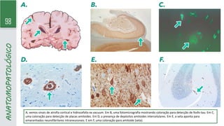 98
ANATOMOPATOLÓGICO
A, vemos sinais de atrofia cortical e hidrocefalia ex vacuum. Em B, uma fotomicrografia mostrando coloração para detecção de fosfo-tau. Em C,
uma coloração para detecção de placas amiloides. Em D, a presença de depósitos amiloides intercelulares. Em E, a seta aponta para
emaranhados neurofibrilares intraneuronais. E em F, uma coloração para amiloide (seta).
 