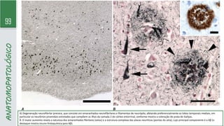 99
ANATOMOPATOLÓGICO
A) Degeneração neurofibrilar precoce, que consiste em emaranhados neurofibrilares e filamentos de neurópilo, afetando preferencialmente os lobos temporais mediais, em
particular os neurônios piramidais estrelados que compõem as ilhas da camada 2 do córtex entorrinal, conforme mostra a coloração de prata de Gallyas.
B. O maior aumento revela a natureza dos emaranhados fibrilares (setas) e a estrutura complexa das placas neuríticas (pontas de seta), cujo principal componente é a Aβ (o
destaque mostra imuno-histoquímica para Aβ).
 