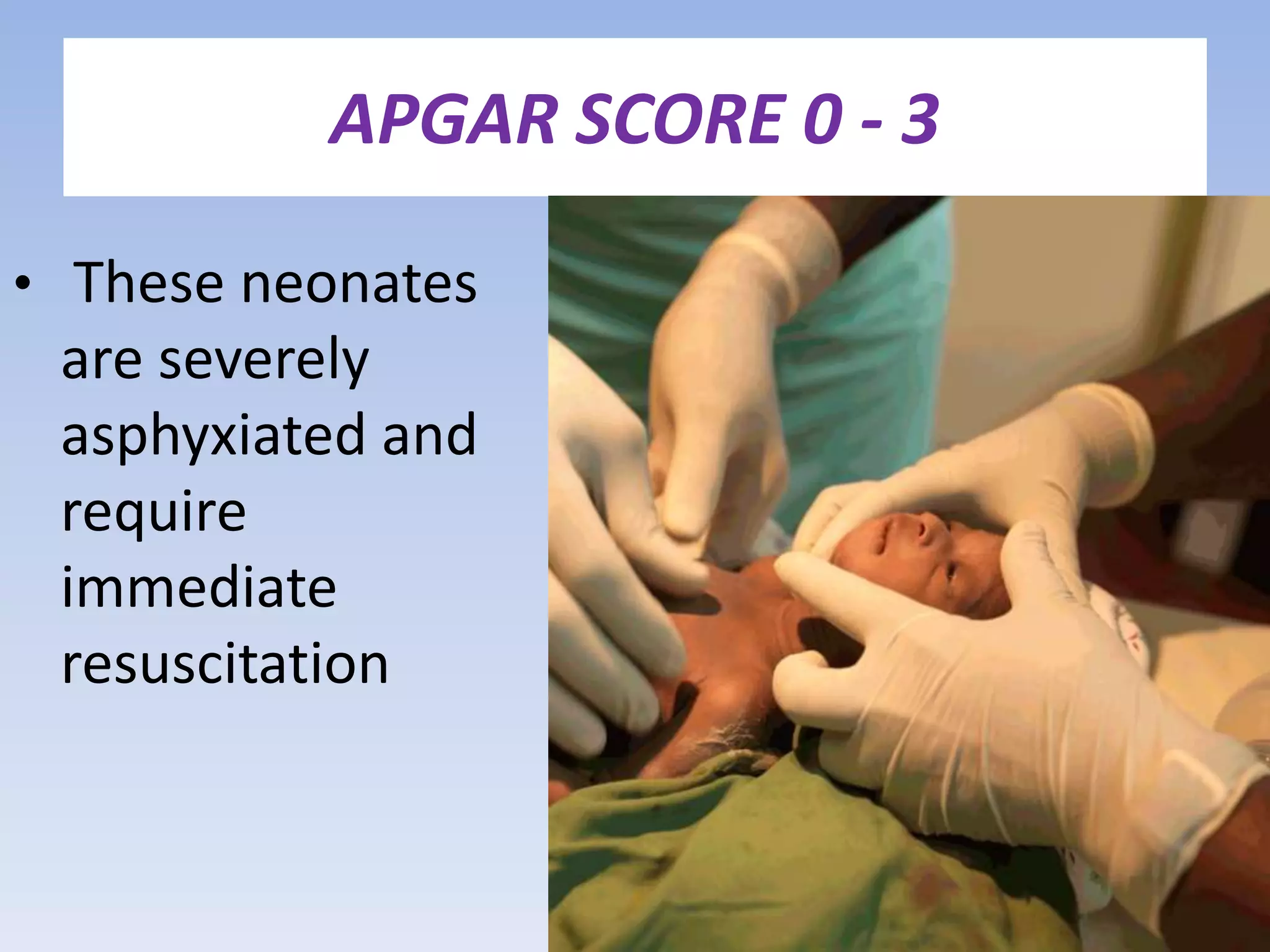 APGAR SCORE 0 - 3
• These neonates
are severely
asphyxiated and
require
immediate
resuscitation
 